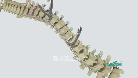 医疗三维动画-脊椎纠正三维动画制作解析