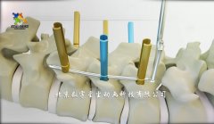 医疗手术动画：微创系统治疗胸腰椎骨折